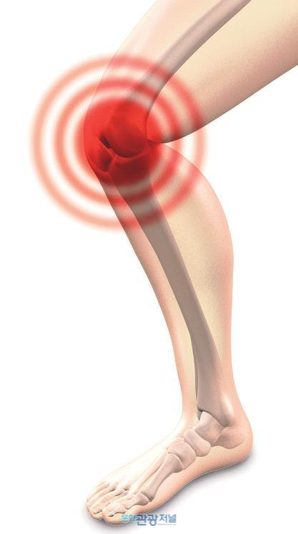 관절수술했더니 상태가 더 나빠졌다?